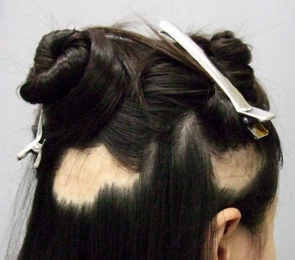 疤痕修復