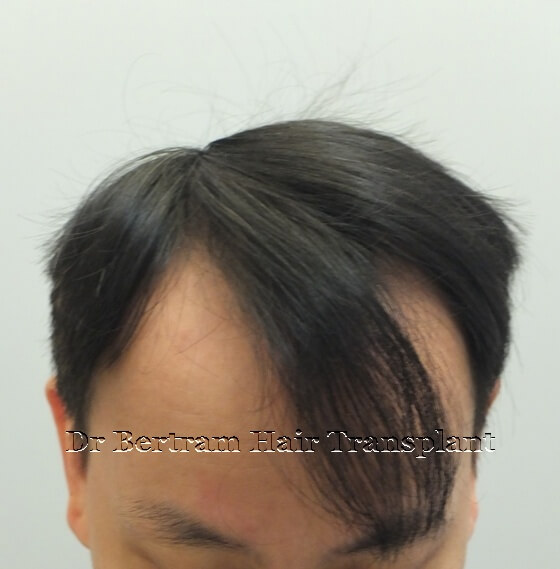 術前：正面角度，IV期脫髮模式