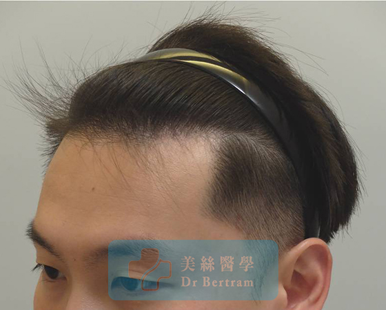 術後：顳部連接恢復