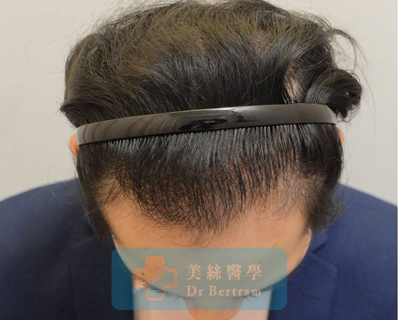 術後：顳部連接恢復