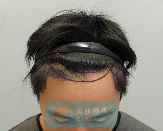 術前：側面顳部後移