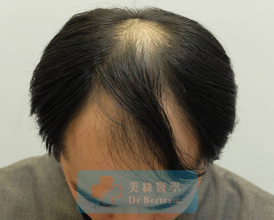 術前：幼細毛髮特性特寫