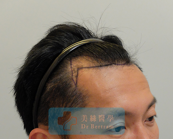 術前：側面顳部後移