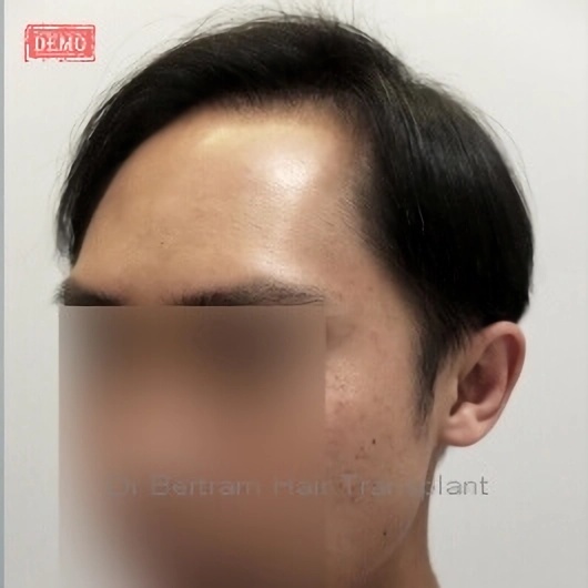 術後12個月：後方角度效果