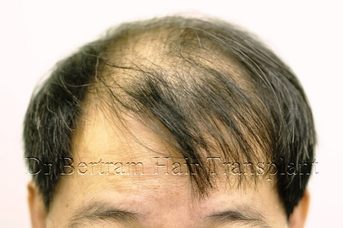 臨床個案：50歲男性