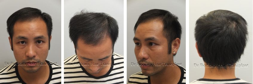術後4個月：早期生長