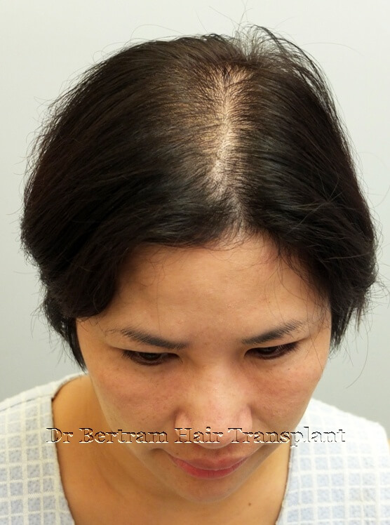 Pre-procedure: Thinning at part line