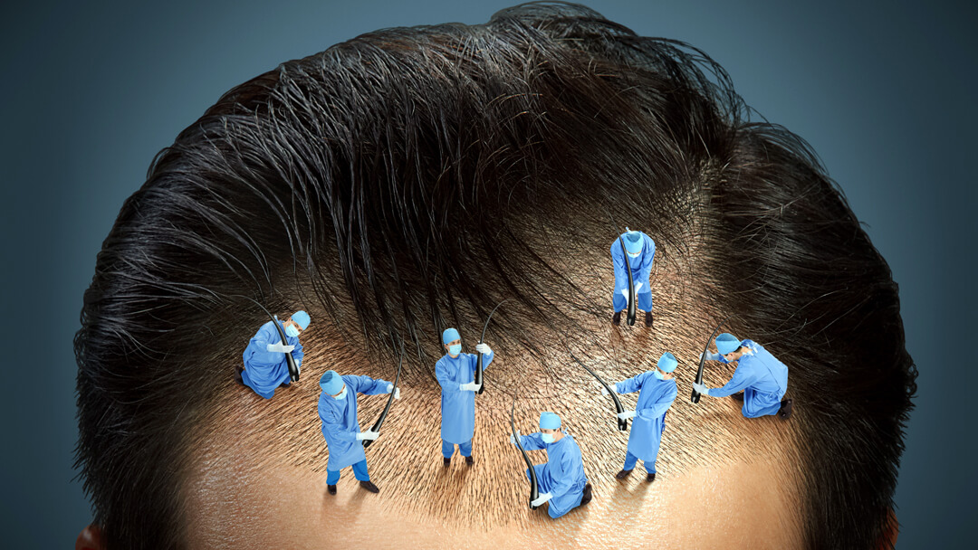 FUE procedure