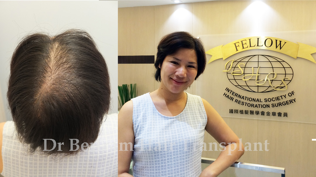 Female hairline assessment