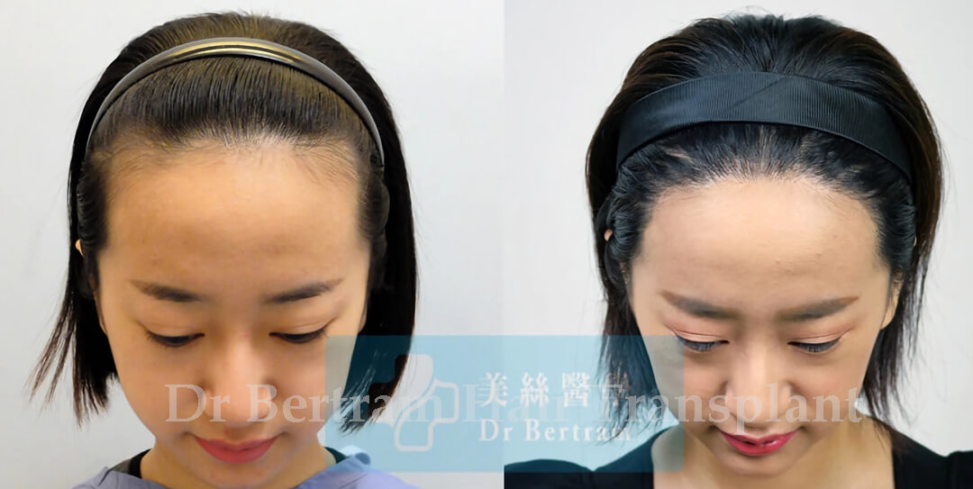 Comparison of hairline shapes